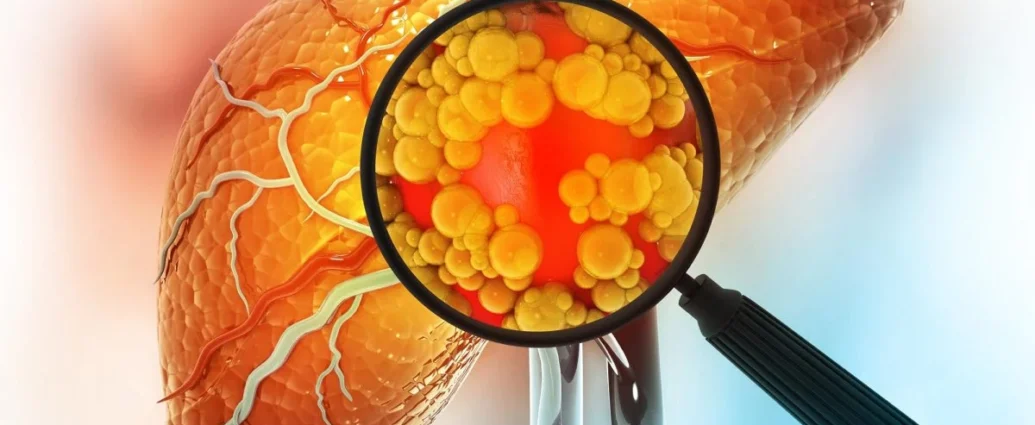 Latest Clinical Research on Reversing Fatty Liver Disease Naturally