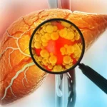 Latest Clinical Research on Reversing Fatty Liver Disease Naturally