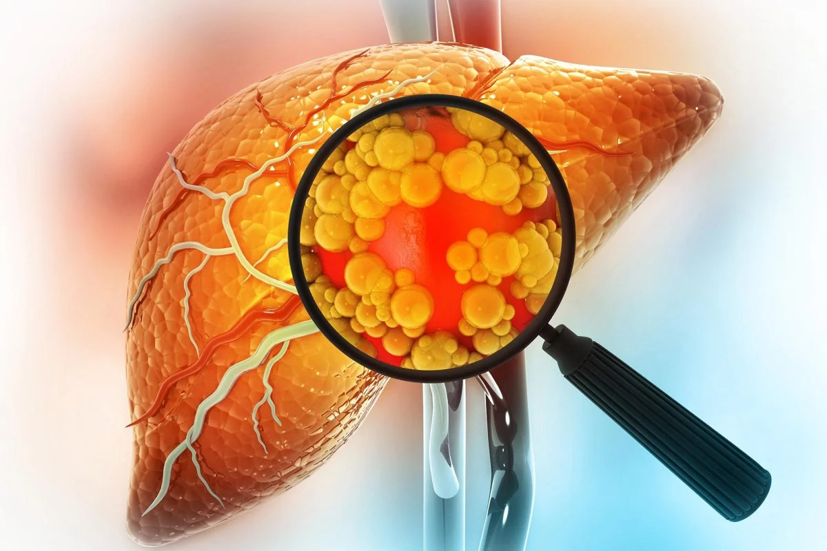 Latest Clinical Research on Reversing Fatty Liver Disease Naturally